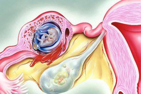 女人宫外孕的常见发病原因竟是它