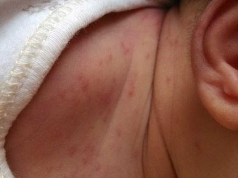 4个月的宝宝有湿疹,有什么办法？
