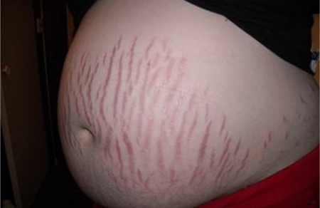 妊娠纹是红色的正常吗 多彩妊娠纹你知道吗