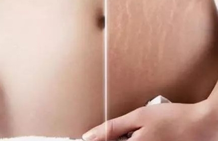 产后怎么消除妊娠纹？3个小偏方，超有效！