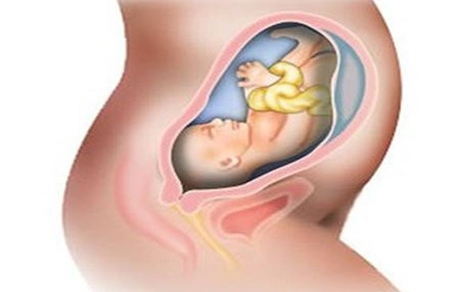 胎粪吸入综合征对婴儿以后的影响 这些危害要知道