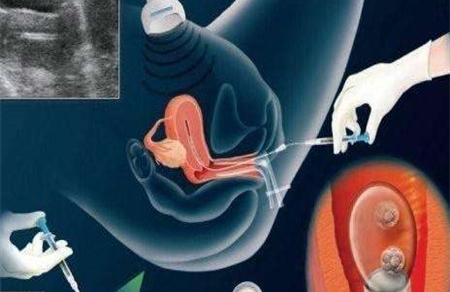 宫腔积血对胎儿有影响吗 孕期你不知道的暗示小点
