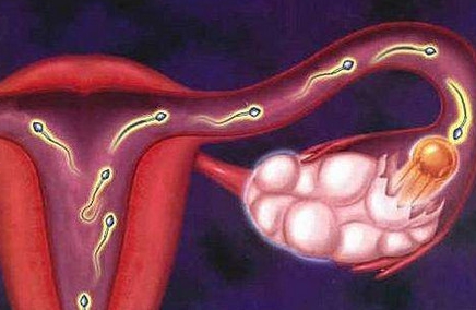 多囊卵巢综合症是遗传的吗？