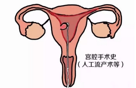 不孕与子宫内膜的厚薄到底有联系吗？