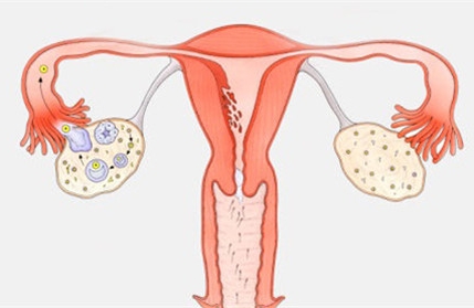 患多囊卵巢的人多吗 多囊是常见疾病吗？