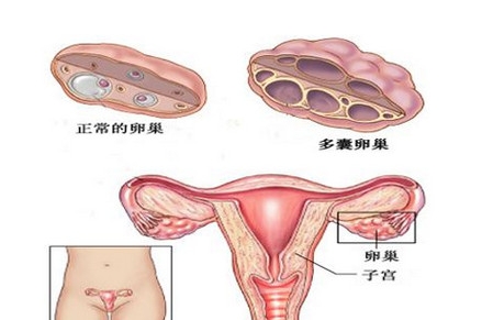 多囊卵巢综合征对后代的影响大吗