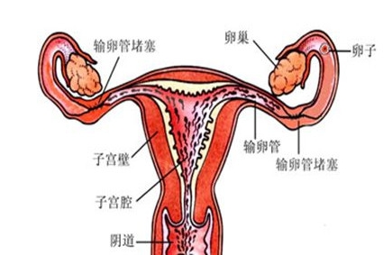 输卵管堵塞是怎么回事？
