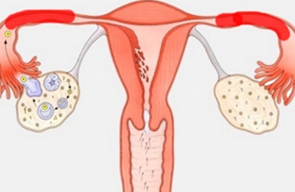 不孕和宫外孕的常见病因：输卵管阻塞