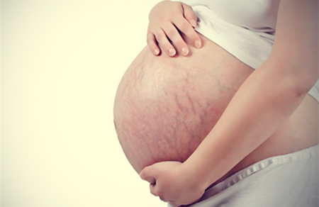 产后妊娠纹要怎么去除 揭秘新妈妈妊娠纹修复方法