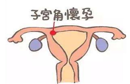 宫腔积血和宫腔积液的区别 这些方面来分辨