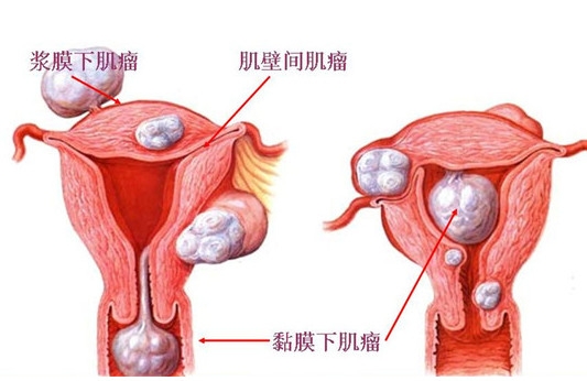 什么是子宫肌瘤？子宫肌瘤的那些事儿
