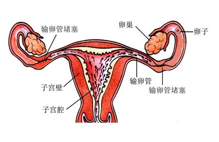 输卵管堵塞了还能怀孕吗？