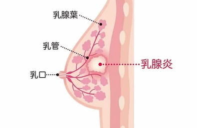 哺乳期乳腺炎怎么办？