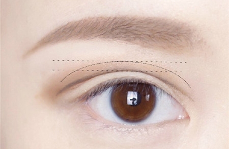 来月经可以做双眼皮手术吗 做双眼皮一定要注意这些！