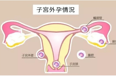 宫外孕能预防？备孕前请小心身体发出的这些信号！