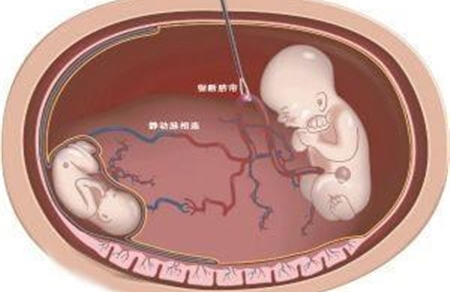 减胎对另一个胎儿有影响吗 减胎知识要了解