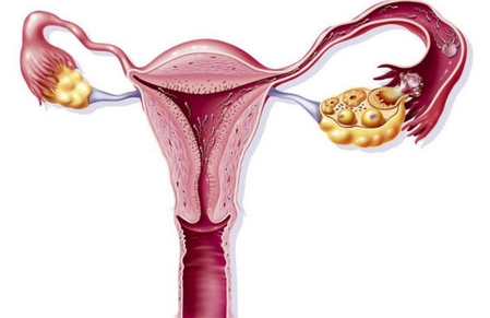 如何精确诊断输卵管性不孕？