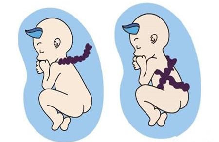 脐带扭转发生在几周 你不知道的孕期小事件