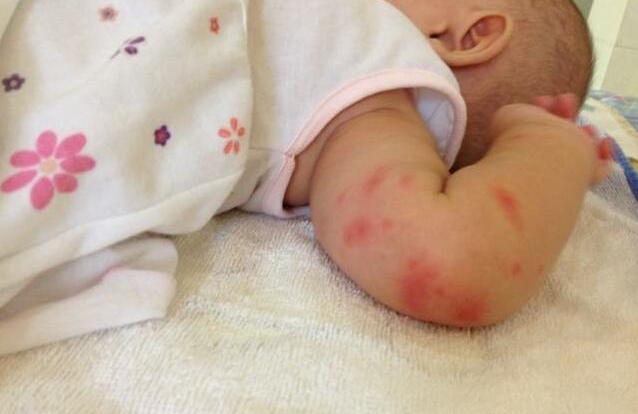 怎么预防小儿丘疹性荨麻疹