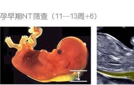 新生儿黄疸原因 孕妇如何在孕期如何预防胎儿黄疸