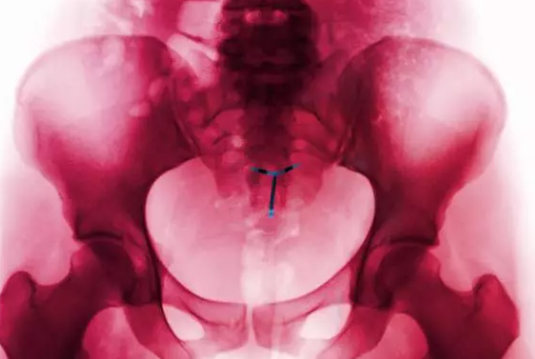 曼月乐环发现卵巢囊肿原因 上曼月乐环的不良反应