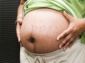 妊娠纹的出现 孕妈还是胎宝该背锅？