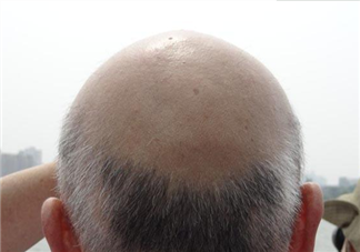 一到中年为什么容易脱发 中年男性秃头怎么办