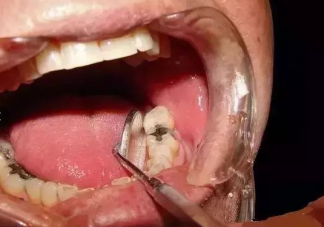 洗牙有哪些作用 多久洗一次牙会比较好
