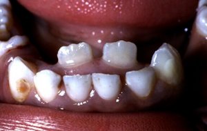 孩子出现双排牙，是否和食物太精细有关？