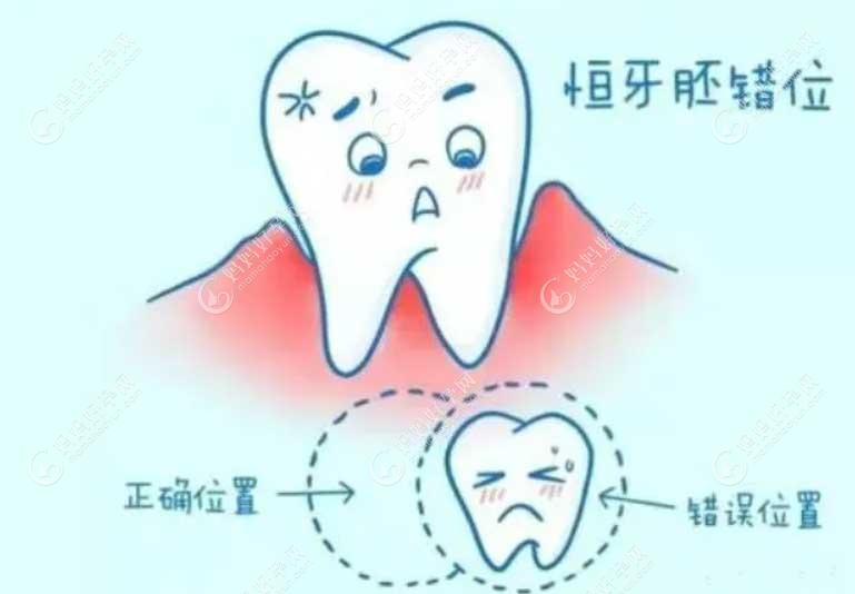 根管治疗对恒牙没有影响