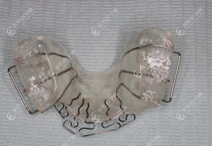 反颌活动矫治器图片