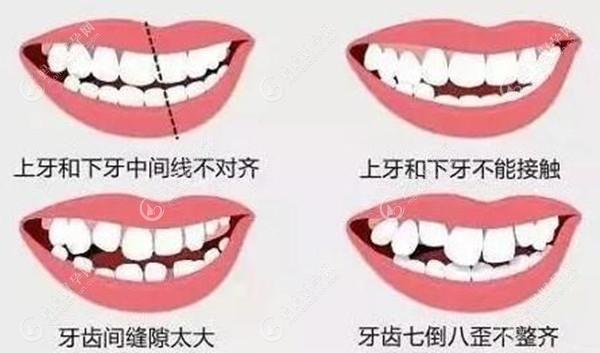 牙齿畸形图