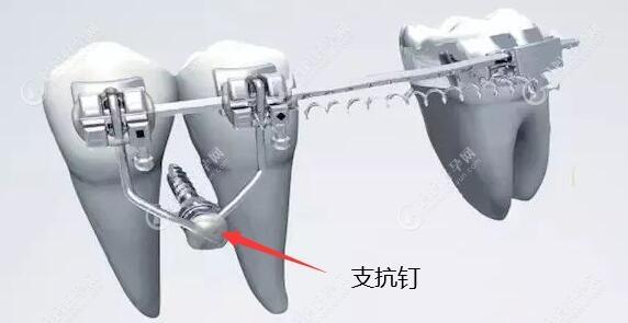 牙齿矫正支抗钉有什么作用