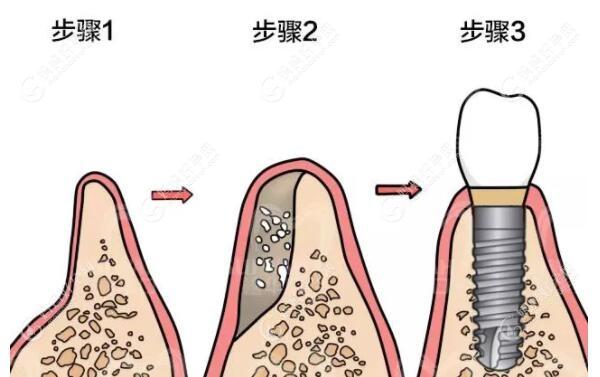 牙槽骨萎缩做种植牙要植入骨粉骨膜能恢复牙床原状吗