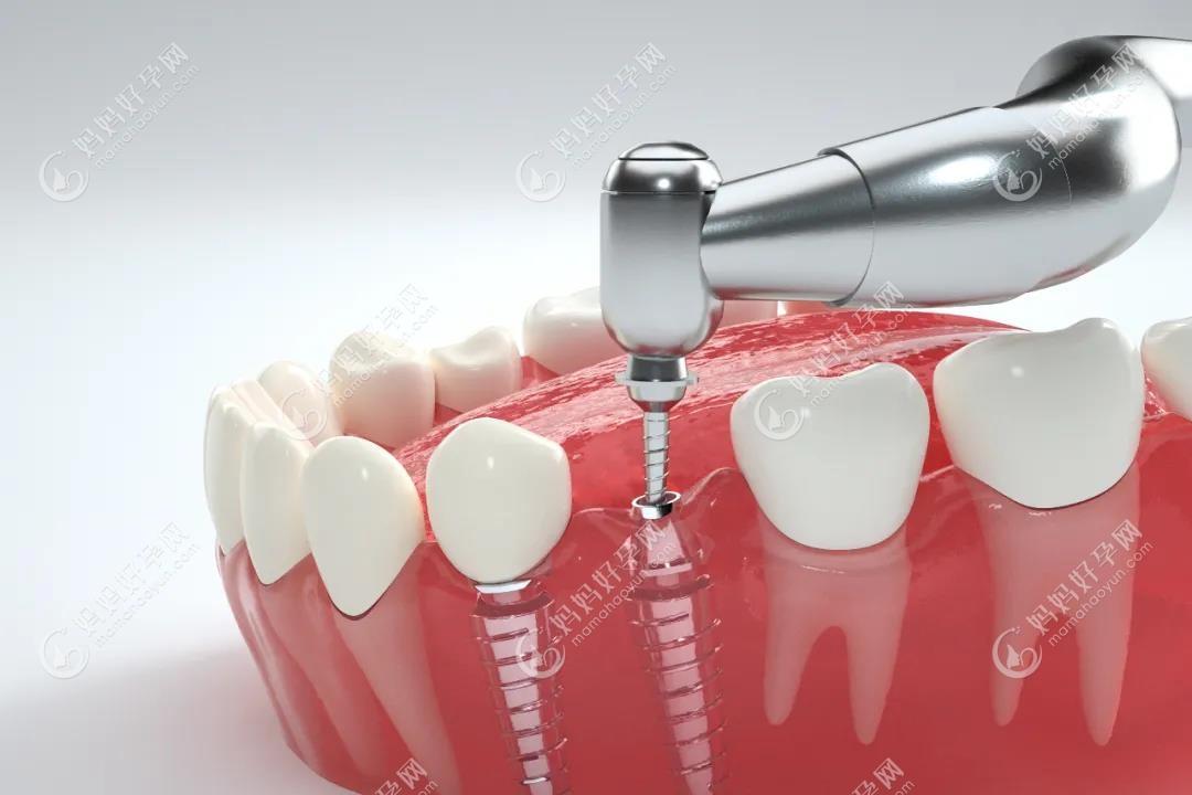 所谓3D数字化微创种植牙与传统种植牙的区别到底在哪里？
