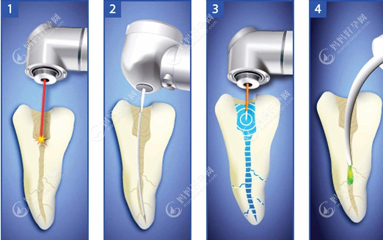 牙齿根管治疗步骤
