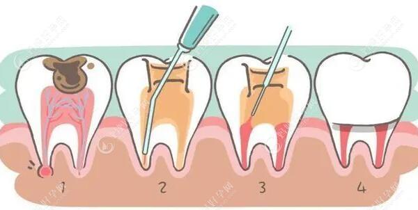 儿童乳牙根管治疗后也有必要做牙冠,金属或透明预成冠即可
