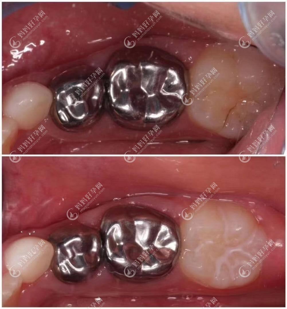 听说儿童补牙被忽悠做牙冠,那乳牙做预成牙冠的危害是啥呢-儿牙-妈妈