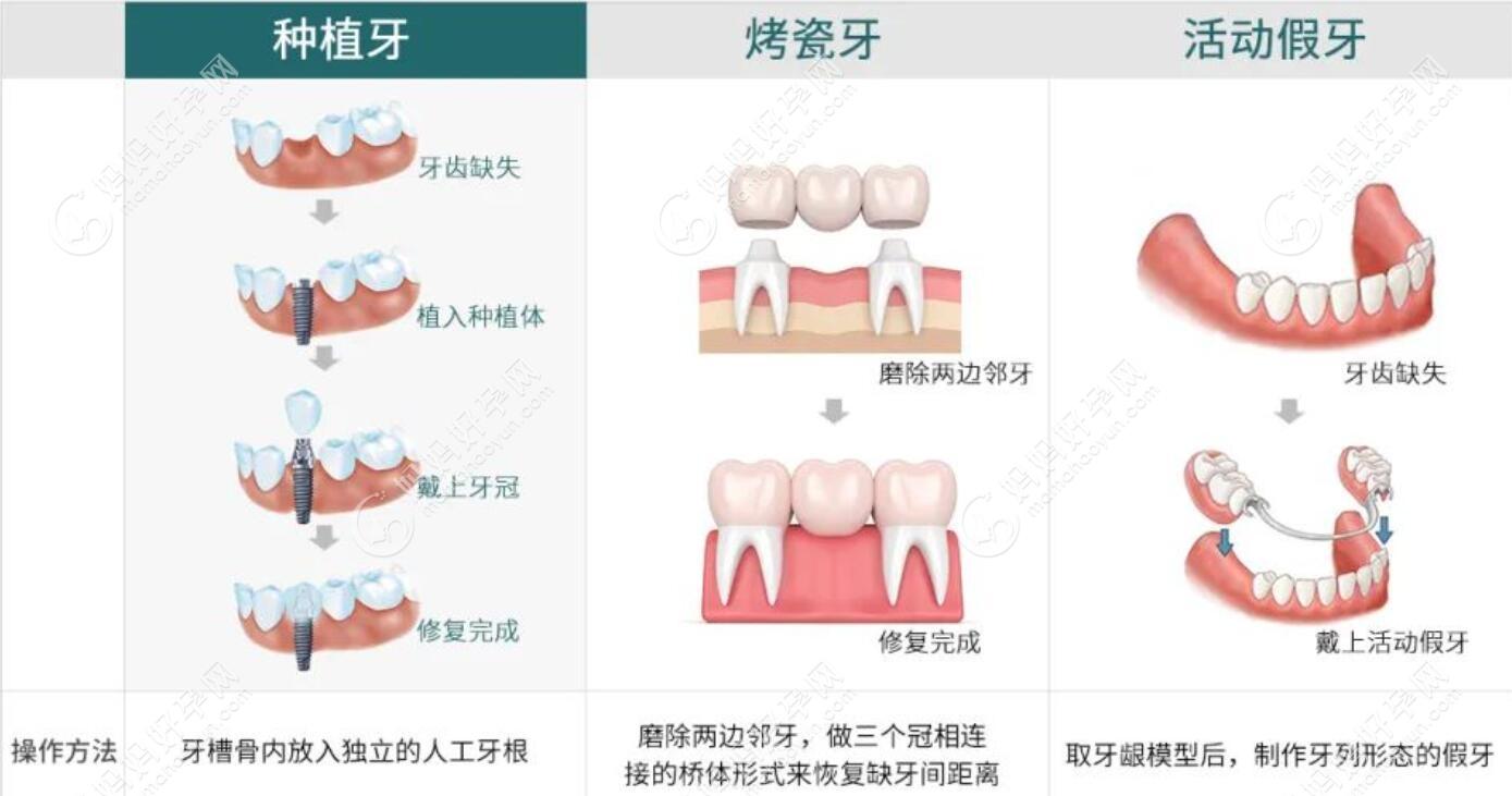 牙齿缺失三种修复方式