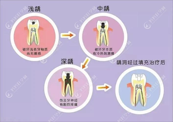 龋齿发展过程示意图