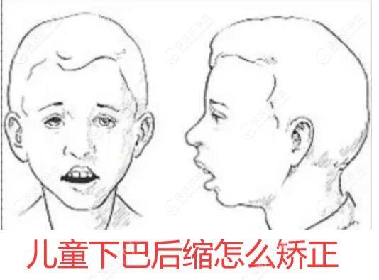 9/10岁儿童下颌后缩怎么矫正?TwinBlock功能矫正器导出后缩下巴