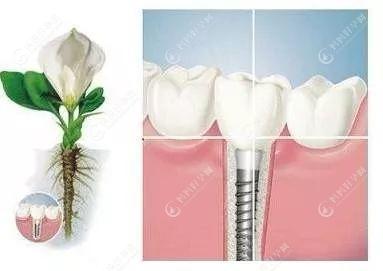 一般种植牙使用年限能用多少年
