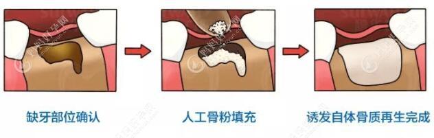 牙槽骨太薄不好种植牙需要植入骨粉