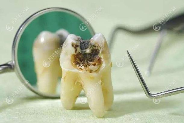 说3-5岁蛀牙洞千万不能补,是以为小蛀牙洞可以保持不变大吗