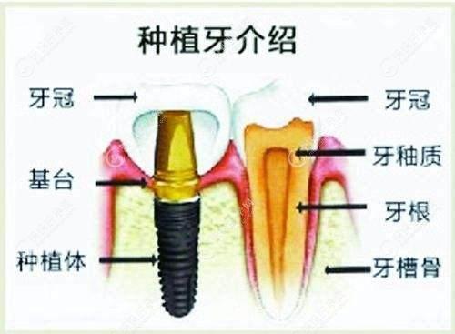 牙槽骨量少能种牙吗