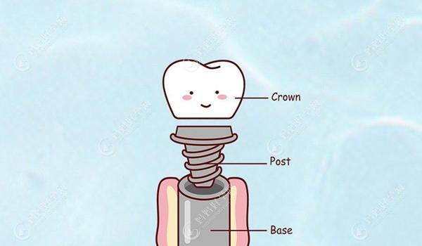 种植牙可分为哪几部分