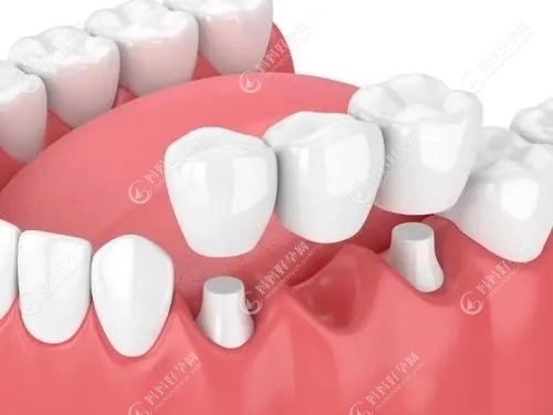 先天性缺牙的治疗期是什么时候