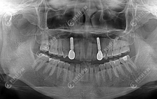 半口半固定种植牙的CT图