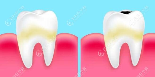 儿童乳牙龋齿补牙后会影响换牙吗,担心材料影响恒牙的生长