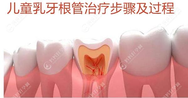 儿童乳牙根管治疗步骤及过程